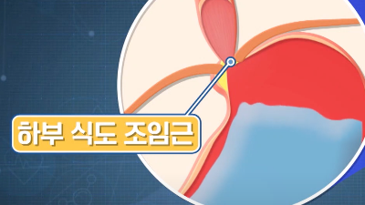 역류성 식도염 증상 잔기침 
