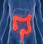 대장암 초기증상