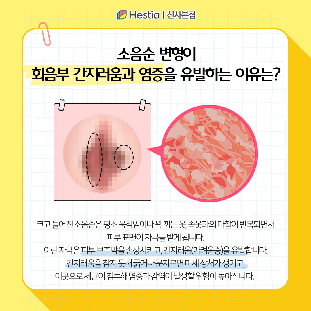 소음순 변형이 회음부 간지러움, 염증을 유발하는 이유는?