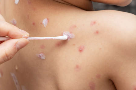 홍역이라 무시하지 마세요! 치명적인 질환이 될 수 있어요.