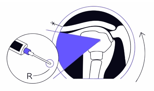 오십견 수술 과정