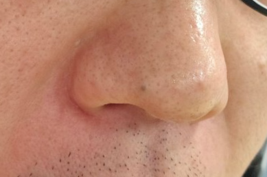 블랙헤드가-생겨난-코