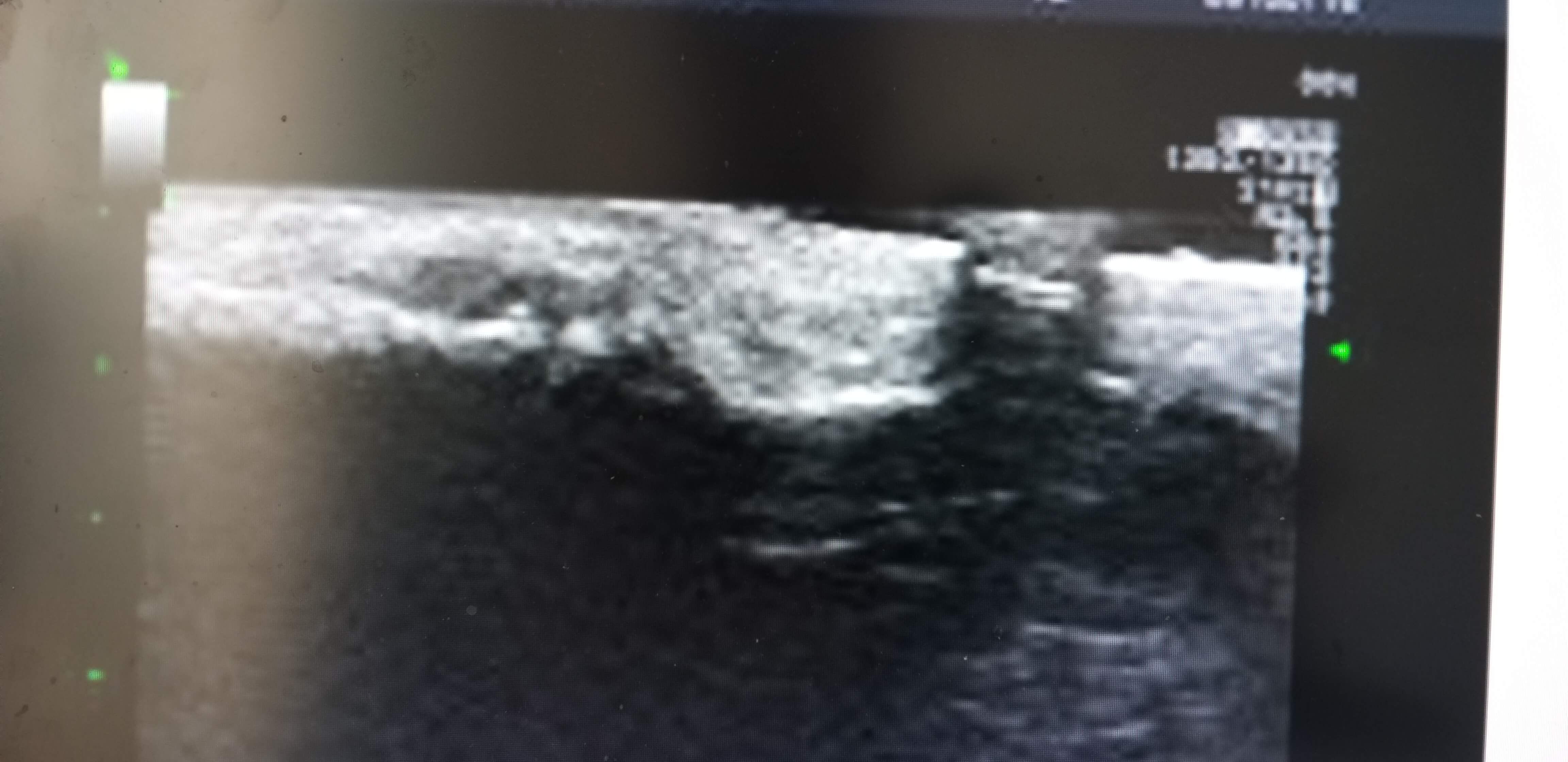 인대파열초음파사진1