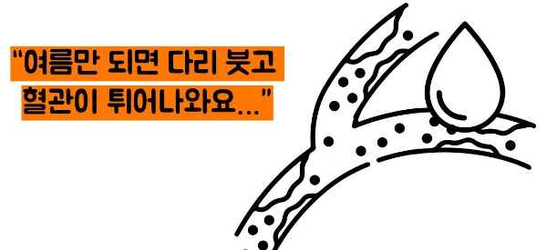 하지 정맥류 증상