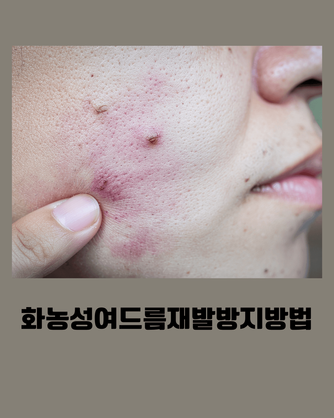 화농성여드름 원인과 재발 방지 관리 방법을 설명하는 피부 관리 정보 이미지로 염증성 여드름의 특징과 올바른 세안법 및 생활습관 개선 팁을 안내하는 스킨케어 가이드 자료