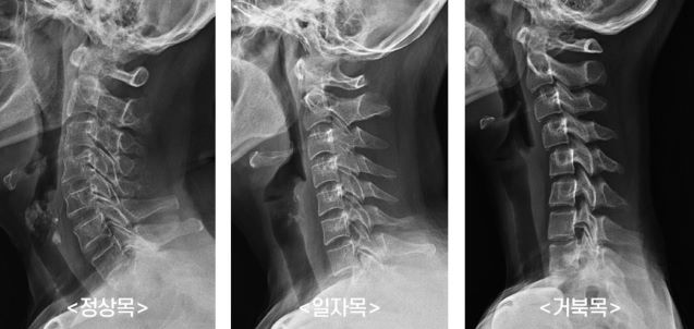 거북목과 정상목 사진비교
