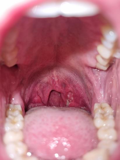 편도염: 원인, 증상, 치료 방법