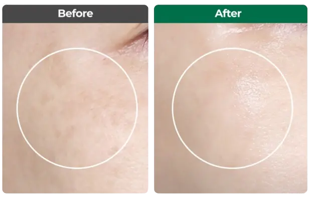 이지듀 기미 앰플 효과