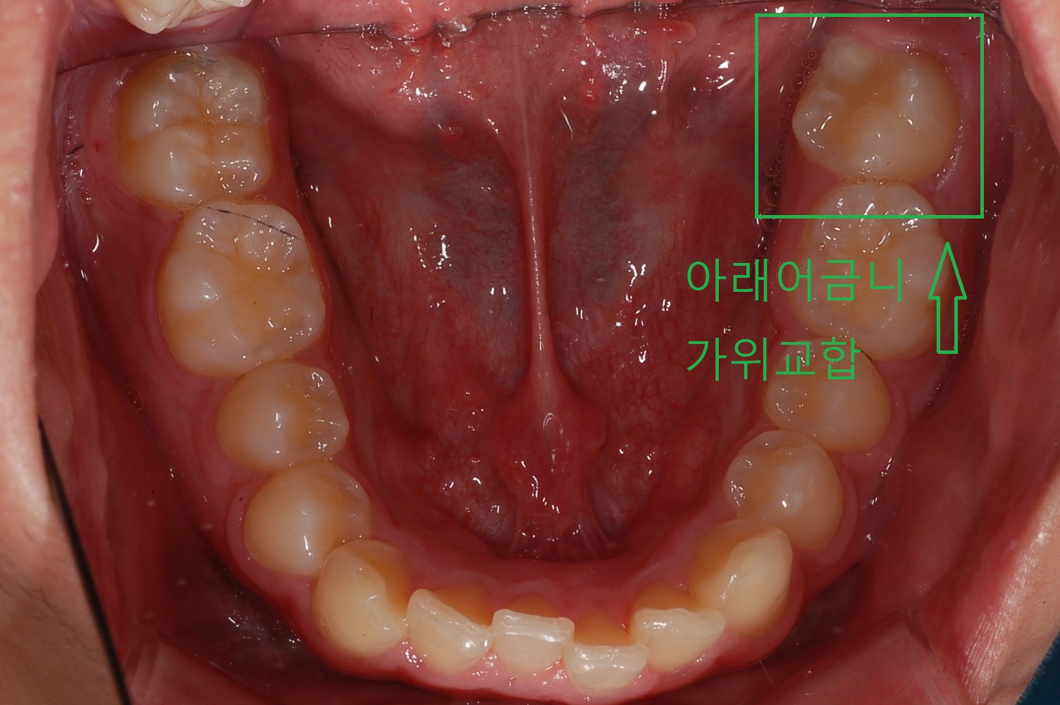 부정교합 가위교합 과개교합 치아교정2