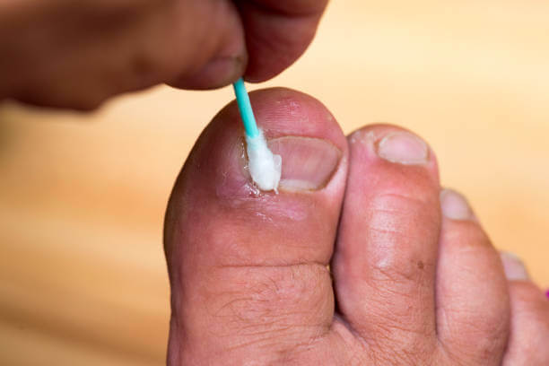 새끼발톱 갈라짐, 원인과 예방방법 때로는 작은 부위에 대한 관심 부족으로 인해 큰 문제가 발생할 수 있습니다. 이번 글에서는 새끼발톱이 갈라지는 이유와 예방 방법, 그리고 집에서 할 수 있는 치료 방법을 참고하시기 바랍니다. 이제부터 새끼발톱에 대한 지식을 쌓아 보세요.