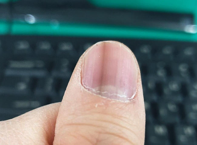 검은세로줄이 생긴 손톱