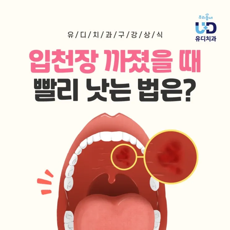 입천장 헐었을 때 면역력 저하 관련 증상과 영양 관리법_4