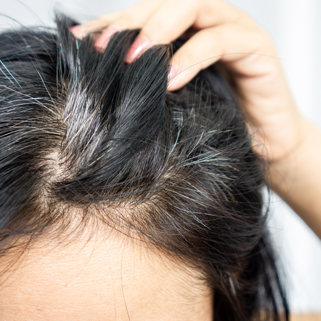 흰머리 나는 이유와 관리 방법, 효과적인 해결책