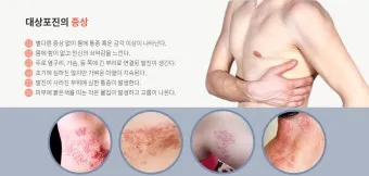 대상포진 치료방법에 대한 총정리 건강 질병관리_5
