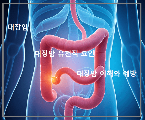 대장암. 대장암 유전적 요인. 대장암 이해. 대장암 예방.
