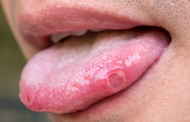 혓바늘 없애는 방법
