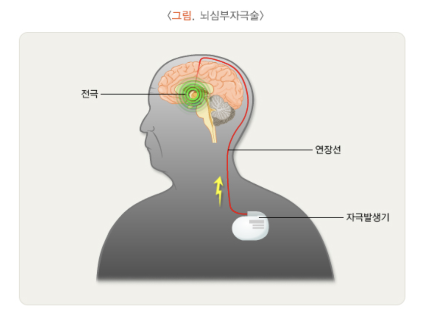 뇌심부자극술