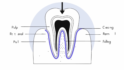 시린이 치료과정