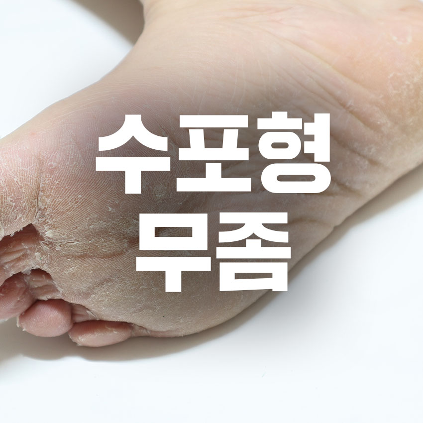 수포형 무좀 원인