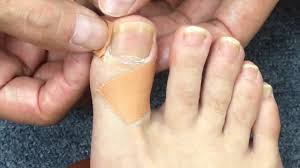 내성발톱 자가치료