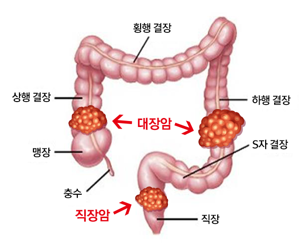 대장암 4기 생존율