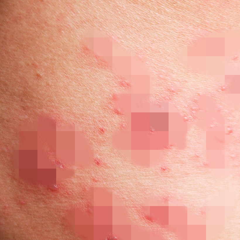 저 역시도 급성기 대상포진이였던터라 결국에는 약을 먹는 것으로 마무리 하였습니다. 혹시 몰라 혈액 검사도 진행하였으나 이상은 없었습니다.