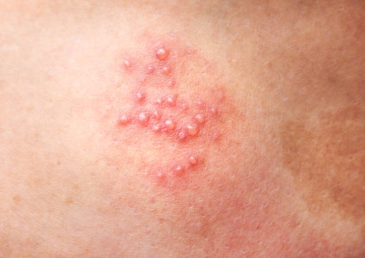 대상포진의 수포