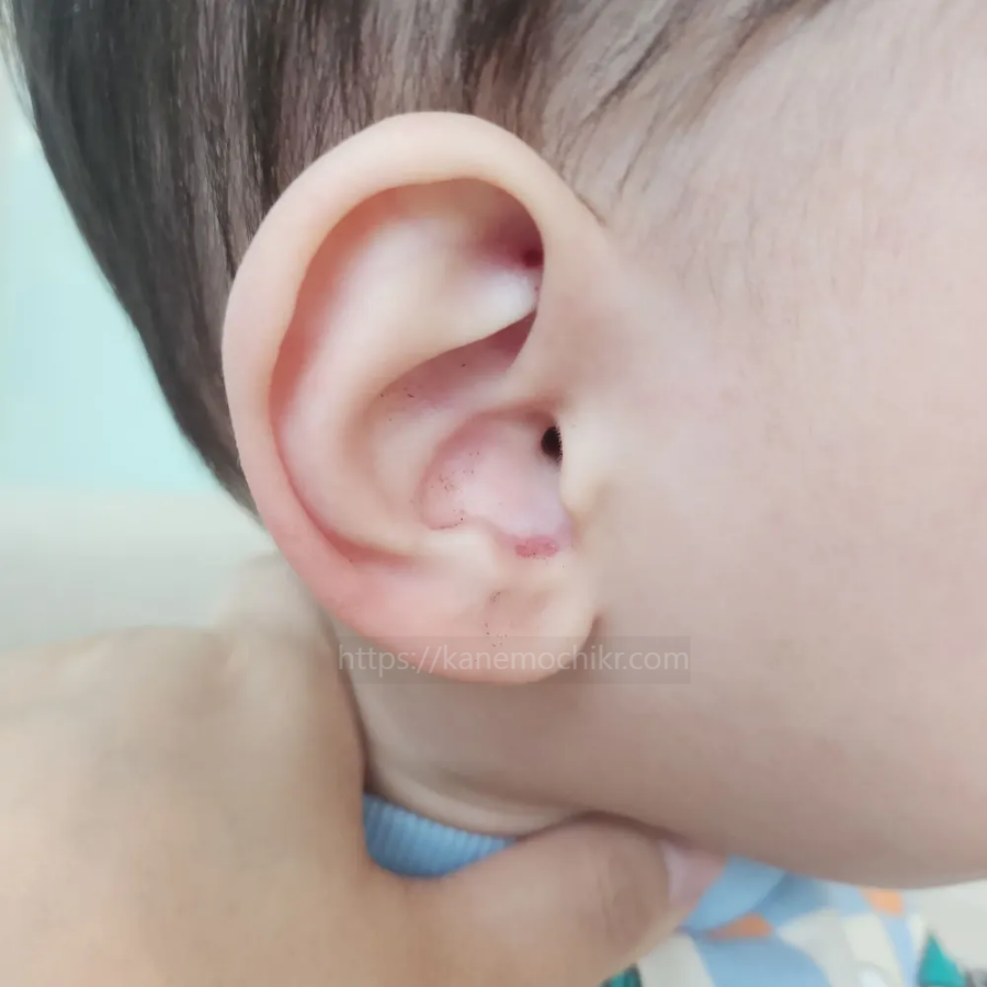 아기-귀-알레르기