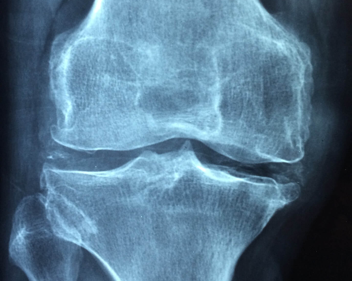 관절염, 류머티즘, 퇴행성관절염