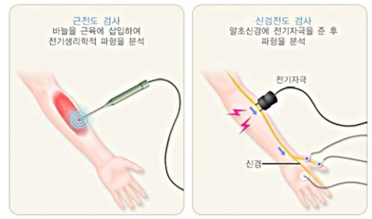 근전도 검사 이미지