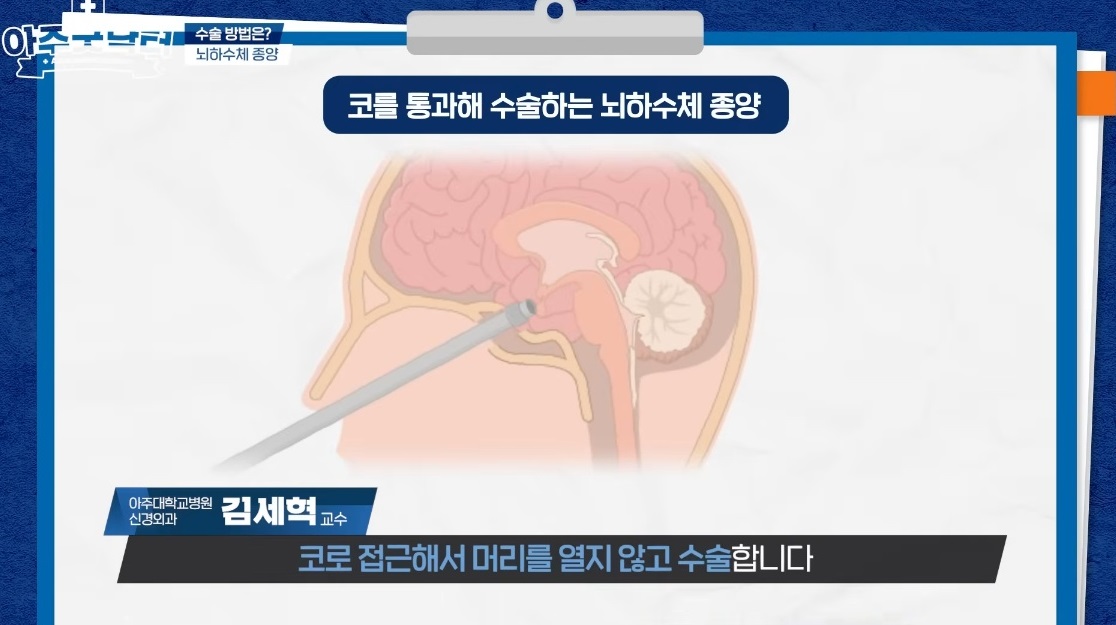 뇌암-수술-방법