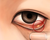 다래끼 약국약 마이노신 치료 효과와 다래끼 원인&amp;#44; 속다래끼 겉다래끼 어떻게 다른지 알아봐요 