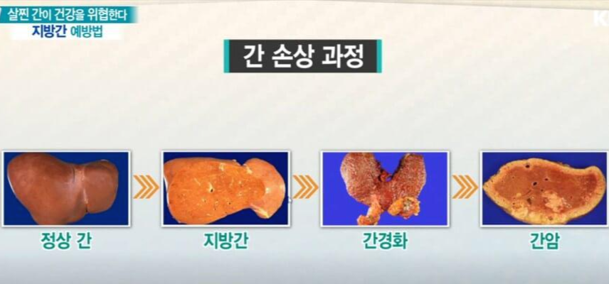 지방간 증상 및 비알콜성 지방간의 원인과 지방간에 좋은 음식 7가지