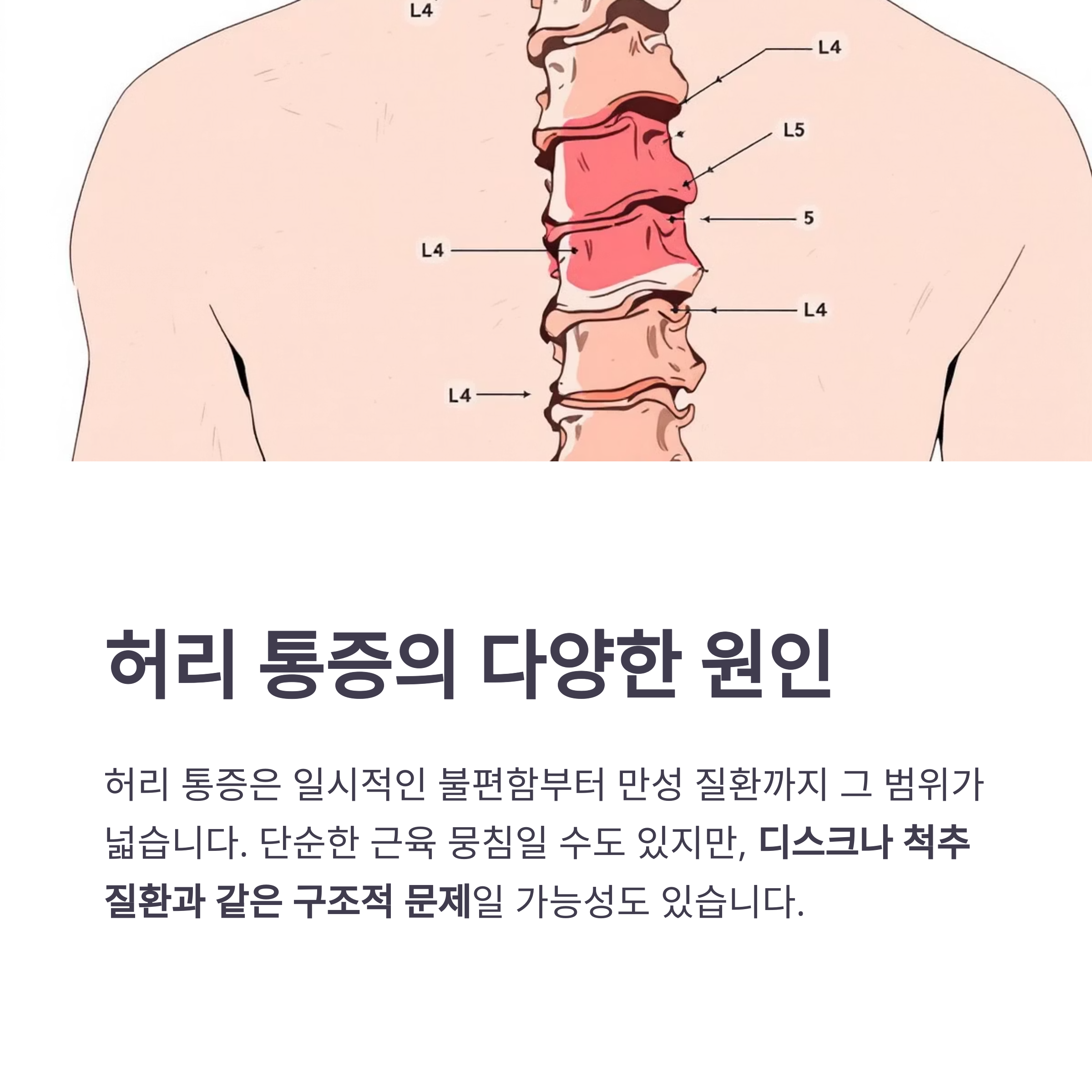 허리 통증의 주요 원인과 증상, 효과적인 치료법 정리