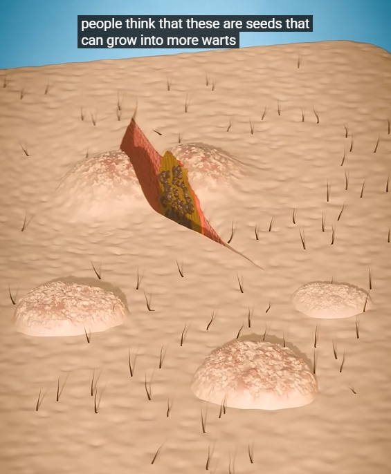 곤지름 초기증상