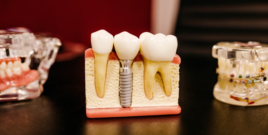 의정부시-임플란트-치과-가격-비용-싼-곳,저렴한-곳,잘하는-곳,유명한-곳-BEST20-추천17