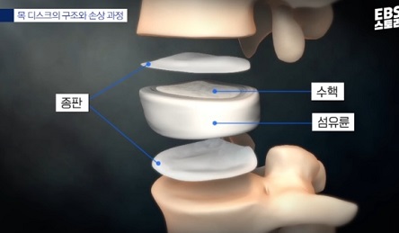 목디스크구조