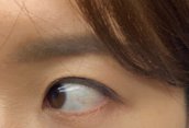 결막모반 제거 후기