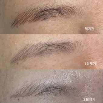눈썹 문신 제거 방법 꿀팁_3
