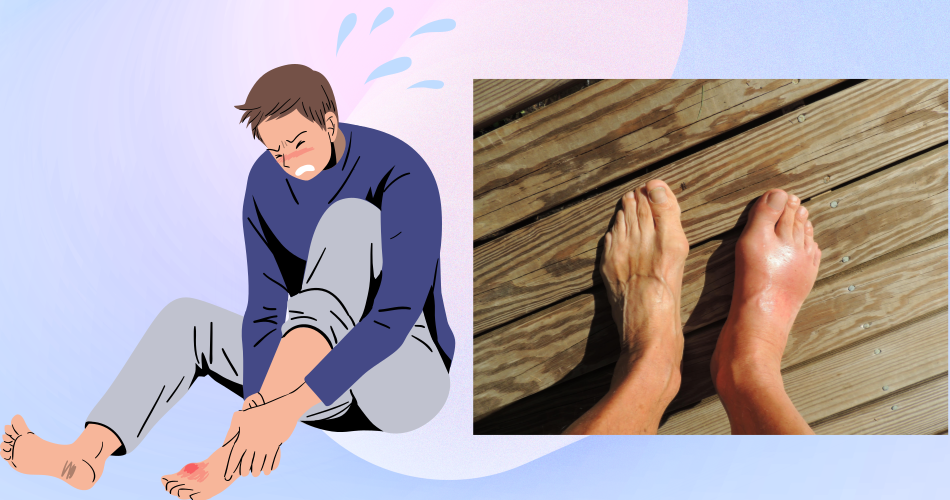 통풍. 통풍발가락