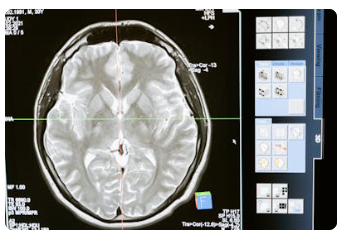 뇌졸증 원인, 증상, 치료, 예방, 질병코드 : 갑자기 찾아오는 불청객