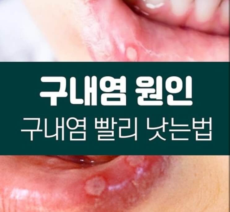구내염 빨리 낫는법