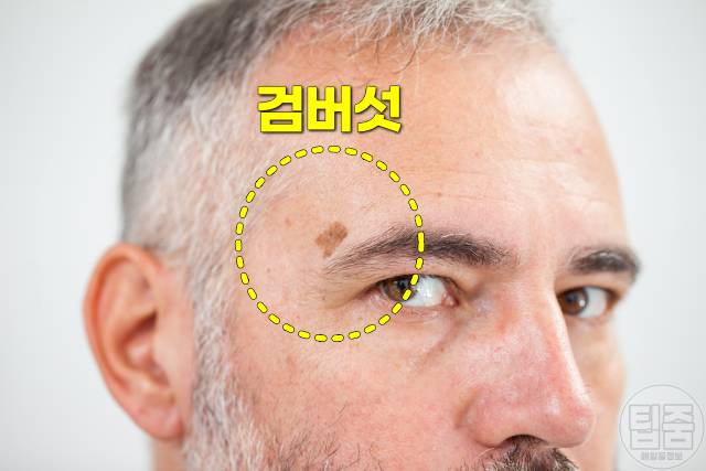 검버섯 제거 방법 검버섯 제거 연고 크림