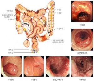 대장암 증상