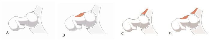 고관절 충돌 증후군