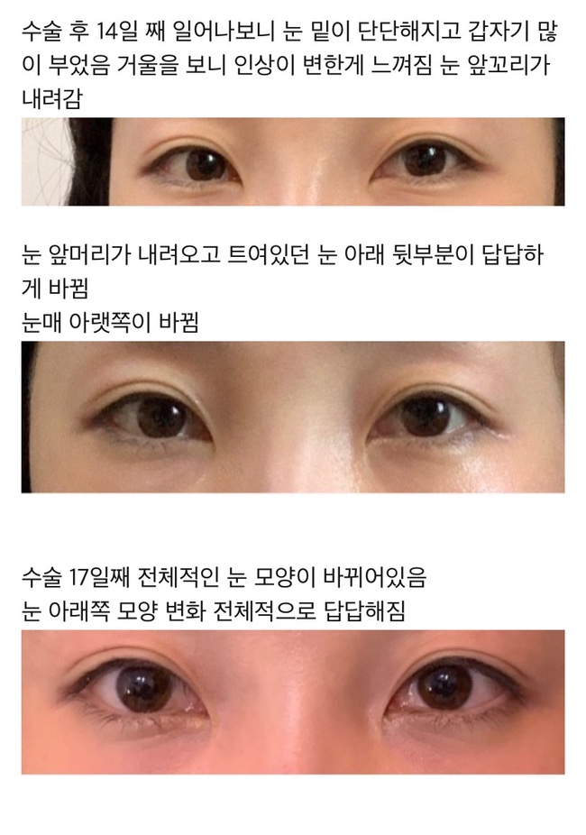 눈밑지방재배치 후기