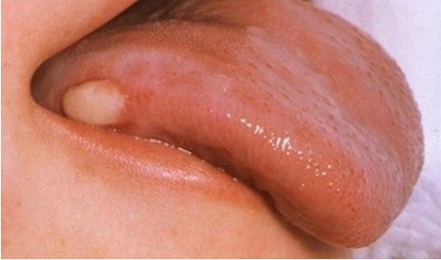 설암(혀암) 초기증상과 원인