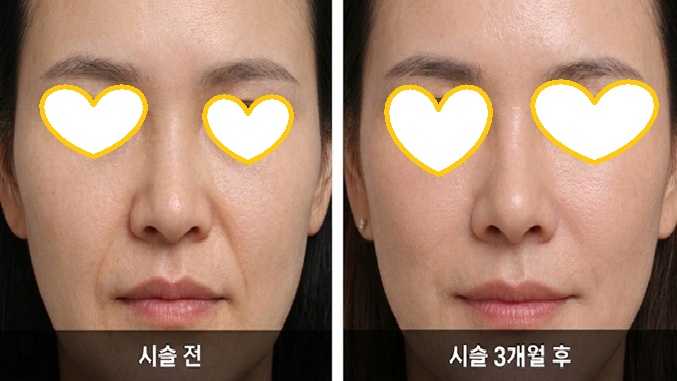팔자주름 쥬베룩 시술 전후 비교 자연스러운 볼륨 변화