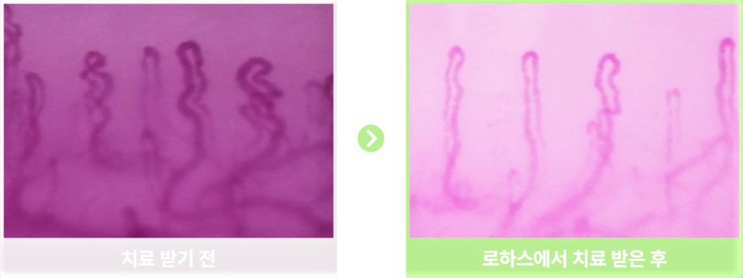금진옥액 치료 전후 모세혈관 비교 사진