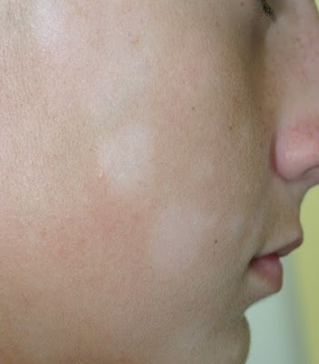 백색비강진의 증상